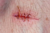 Self-inflicted laceration and sutures