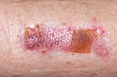 Skin graft donor site on the thigh