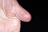 Thumb amputation for cancer
