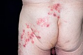 Shingles rash on the buttock