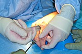 Knuckle joint replacement surgery