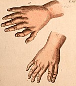 Extra fingers - polydactyly illustration