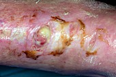 Infected ulcer on the foot