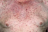Eczema on the chest