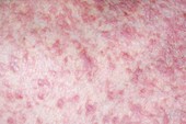 Eczema on the skin