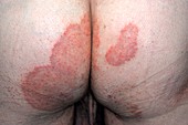 Tinea infection on the buttocks