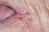 Skin cracking (cheilitis) at the mouth