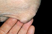 Rheumatoid arthritis of the elbow