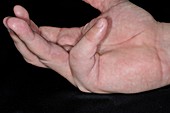 Dupuytrens contracture