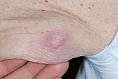 Metastatic cancer on the arm