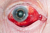 Subconjunctival haemorrhage of the eye
