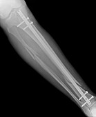 Fixed leg fracture in osteoporosis,X-ray
