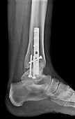 Pinned ankle fracture,X-ray