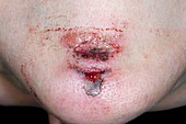 Chin laceration after a fall