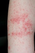 Lesions from hand,foot & mouth disease