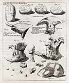 Kidney stones,18th century