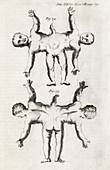 Conjoined twins,18th century