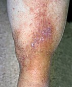 Varicose eczema