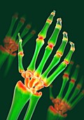 Arthritic hand,X-ray artwork