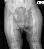 Congenital hip dislocation,X-ray