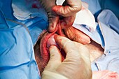 Epididymal cyst removal surgery