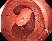 Tubular polyp in the colon