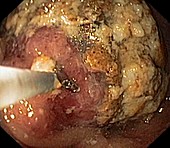Food retention from gastric cancer