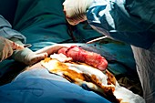Gall bladder removal surgery