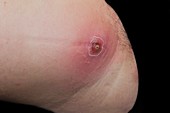 Abscess on the thigh