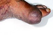 Acute gout of the big toe