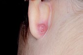 Ear piercing infection