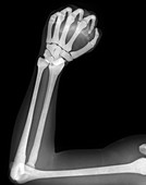Clenched fist,X-ray