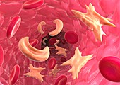 Sickle cell anaemia,artwork