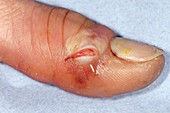 Drained abscess on the thumb