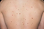 Moles on the skin of the back