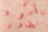 Keloid scarring from acne