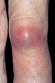 Bursitis of the knee