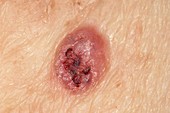 Basal cell (skin) cancer on the arm