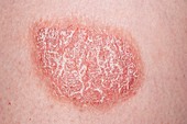 Plaque psoriasis on the skin