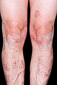 Plaque psoriasis on the legs