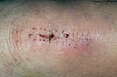 Surgical scar on the leg