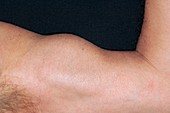 Ruptured head of biceps tendon