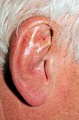 Damaged ear from playing rugby