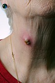 Infected cyst on the neck