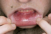 Mouth ulcers from drug treatment