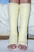 Leg casts for achilles tendon ruptures