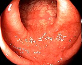 Ulcerative colitis in the colon