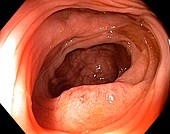 Cancer of the colon