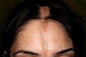 Linear scleroderma on the forehead