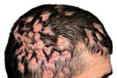 Dissecting folliculitis on the scalp